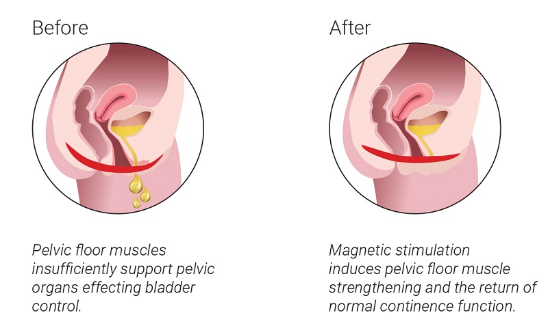 Before-and-after diagram of pelvic floor support, highlighting magnetic stimulation improving bladder control.