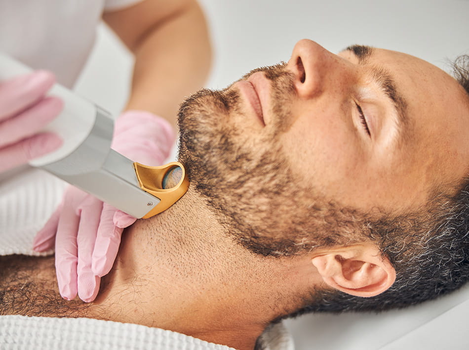 Hair removal for neck hair Man receiving laser hair removal on neck and beard area, highlighting professional grooming treatment.